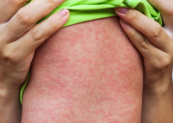 waspada penularan campak