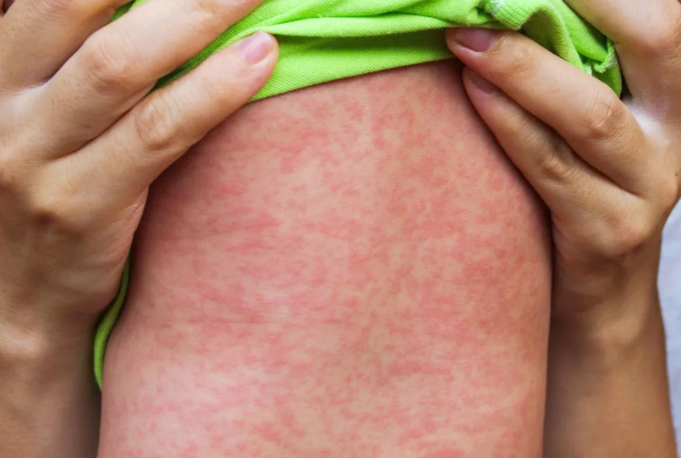 waspada penularan campak